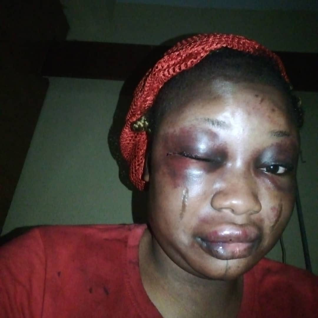This Lady May Lose Her Eyes After Her Husband Brutally Assaulted Her For This Reason