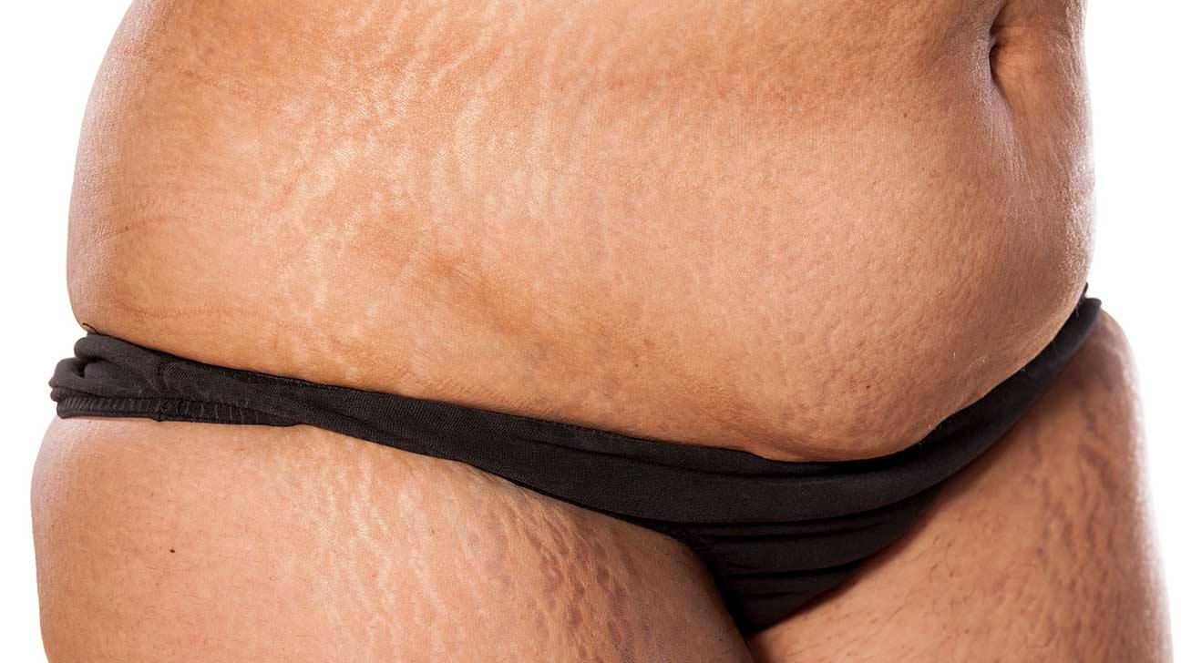Naked pictures of girls with stretch marks