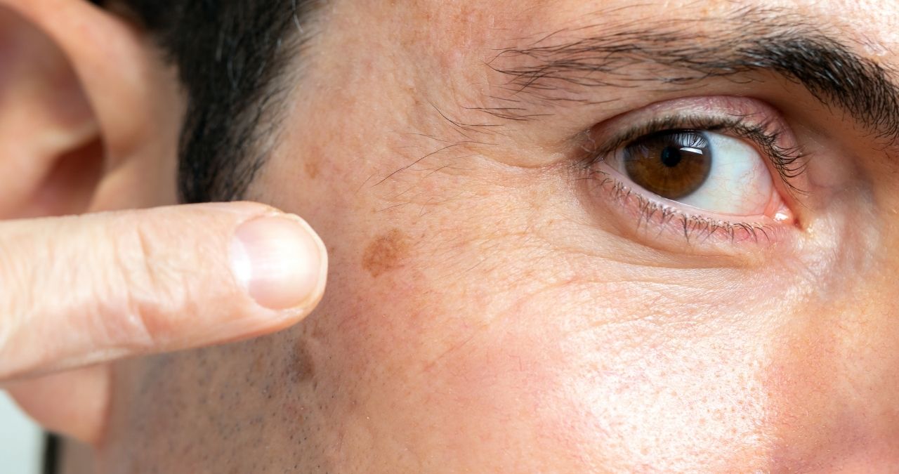 3 Reasons Your Pimple Keeps Turning Black Spot