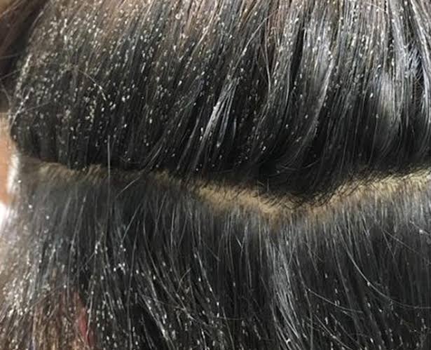 How to Remove Lice Eggs from the Hair