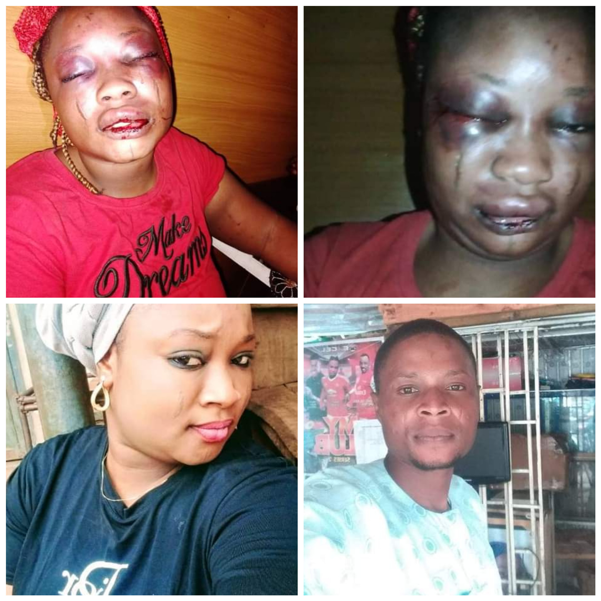 This Lady May Lose Her Eyes After Her Husband Brutally Assaulted Her For This Reason